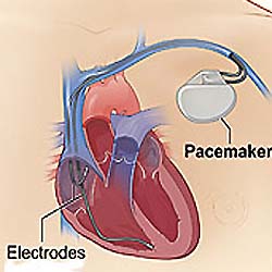 pacemaker